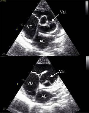 Válvula única (Val.), tricúspide, junto ao trato de saída do ventrículo direito (VD) e aurícula esquerda (AE) – (janela paraesternal eixo curto).
