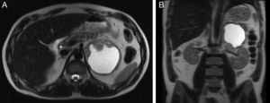 Abdominal magnetic resonance imaging: T2-weighted transverse (A) and coronal (B) views showing a nodular formation on the left adrenal gland with major axis diameter of 9.8 cm, predominantly cystic, with thickened irregular walls and a solid component in the anterior, medial and inferior portions (maximum thickness 4 cm), with heterogeneous late enhancement after contrast administration and diffusion restriction.