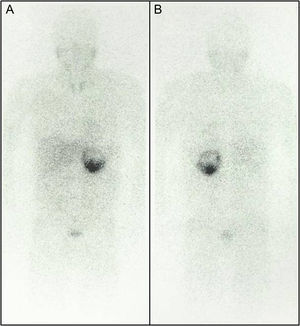 Body metaiodobenzylguanidine scintigraphy scan 24 hours after intravenous contrast administration in anterior (A) and posterior (B) views showing a pathological accumulation in the left adrenal gland compatible with pheochromocytoma (note the preferential distribution corresponding to the tumor's solid part); no other uptake foci are evident.