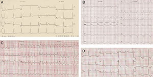 Electrocardiographic changes in the patient throughout life. (A) PR interval 0.11 s; LVH/ST-T pattern (1997, age 44 years); (B) marked LVH and ST-T abnormalities (2007, age 54 years); (C) atrial fibrillation (2010, age 57 years); (D) recent ECG (2012, age 59 years).