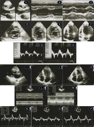 Transthoracic echocardiogram/Doppler imaging. Top (1998, age 45 years): long-axis view showing mild septal thickening, non-dilated and normally contracting left ventricle, and normal left atrium (A, B, C); short-axis view at the level of the mitral leaflet tips (D) and mid-cavity (E); apical 4-chamber view showing slight thickening of the lateral-apical wall (F); middle (2007, age 54 years) – normal tissue Doppler imaging at the septal (G) and lateral (H) corners of the mitral annulus; bottom (2012, age 59-years) – thickened septum (I, J, M – 20 mm); thickened lateral-apical wall (J); non-dilated and normally contracting left ventricle (M); dilated left atrium, 51 mm (L); mild mitral regurgitation (K); diastolic dysfunction and affected longitudinal systolic LV function (N, O, P – see text for details).