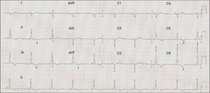 ECG showing sinus rhythm at 71 bpm, PR interval 120 ms, right axis deviation, poor R-wave progression in the precordial leads, inferolateral repolarization abnormalities and negative T wave in V5-V6, II, III and aVF (asterisk).