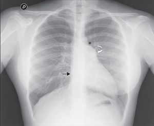 Posterior–anterior chest X-ray showing levoposition of the heart without tracheal deviation, right heart border superimposed on the spine (straight arrow), imprint of the main pulmonary artery (curved arrow), interposition of lung parenchyma between the aortic arch and left pulmonary artery (asterisk) and flattening and elongation of the left ventricular contour (Snoopy sign).