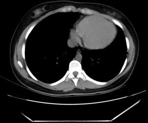 Axial non-enhanced chest computed tomography showing displacement of the heart with the apex in left posterior position. Parietal pericardium cannot be observed between epicardial and mediastinal fat.