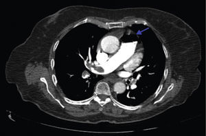 Air in the brachiocephalic veins and pulmonary artery (blue arrow).