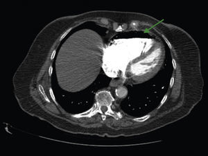 Air in the right ventricle, coronal view (green arrow).