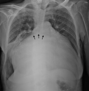 Radiografia de tórax, projeção póstero‐anterior mostrando cardiomegalia acentuada (índice cardiotorácico 0,92) e alargamento do ângulo da carina (setas).