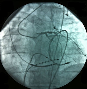 Manuseamento do cateter de mapeamento/ablação no espaço pericárdico com coronariografia.