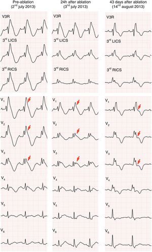 Comparação do eletrocardiograma de superfície antes e depois do procedimento de ablação.