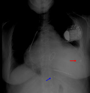 Radiografia de tórax (AP). Seta azul: eletrocateter em veia posterior. Seta vermelha: eletrocateter epicárdico em posição lateral.