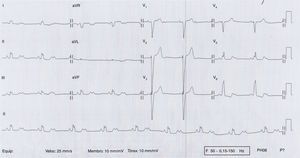 Eletrocardiograma com BAV de 2:1.