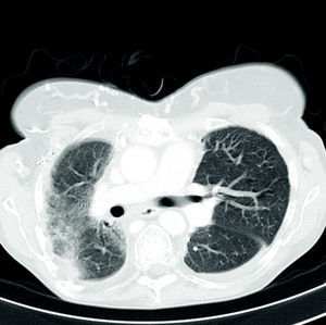 TAC torácica de alta resolução – fibrose torácica difusa e desvio do mediastino.