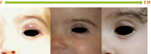 A four-month-old girl who presented with a large hemangioma on the left upper eyelid, showing complete involution of the lesions after five months of oral propranolol. M: months.