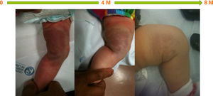 A two-month-old boy who presented with hemangioma on the left thigh, showing complete involution of the lesion on thigh and scrotum after eight months of therapy. M: months.
