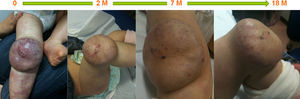 A ten-month-old boy with hemangioma on the right patella and upper right leg, showing a fair response after 18 months of therapy. M: months.