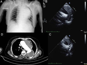 Radiografia torácica com alargamento mediastínico acentuado (A), ecocardiograma transtorácico, incidência supraesternal (B e C – eixo curto), a mostrar aneurisma da crossa da aorta e da parte proximal da aorta descendente, com imagem sugestiva de trombo volumoso, organizado, ao nível de sua parede; e angio‐TC torácico com aneurisma da crossa e aorta descendente com diâmetro máximo de 7cm e volumoso trombo mural sem sinais de síndrome aórtica aguda.