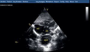 Ecocardiografia transtorácica, plano subcostal quatro câmaras: dilatação aneurismática do ramo direito da artéria pulmonar (apd) que comprime a aurícula esquerda (ae).
