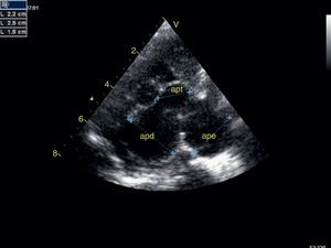 Ecocardiografia transtorácica, plano paraesternal eixo curto: dilatação aneurismática do tronco da artéria pulmonar (apt) e ramos esquerdo (ape) e direito (apd) (apt=15mm, ape=22mm, apd=25mm).