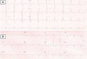 Eletrocardiograma de 12 derivações, antes (A) e depois (B) da implantação de sistema de pacing biventricular, revelando uma rotação do eixo para a direita, bem como uma redução da duração do QRS de 196ms para 144ms.