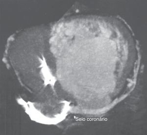 Angiografia coronária por tomografia computorizada revelando o seio coronário permeável, bem como as suas tributárias.