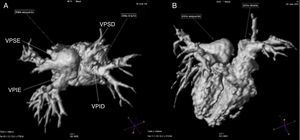 Angiorressonância de veias pulmonares: imagens tridimensionais em visão superior (A) e posterior (B). Exame confirma a presença de drenagem anômala parcial de veias pulmonares, com duas veias pulmonares drenando em cada um dos átrios.