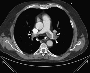 Corte axial de tomografia computorizada com contraste endovenoso mostrando defeitos de perfusão em ambas as artérias pulmonares e na emergência das várias artérias lobares.