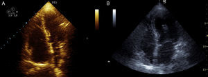 A ‐ Ecocardiograma transtorácico em apical quatro câmaras realizado na sala de emergência revelando dilatação marcada das câmaras direitas e rectificação do septo interventricular. B ‐ Ecocardiograma transtorácico realizado um mês após a alta sem alterações significativas.