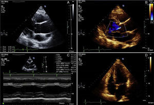 Transthoracic echocardiogram showing mild dilatation of the aortic root and ascending aorta, with maximum diameter of 42 mm (A); mild aortic regurgitation (B); left ventricle with normal dimensions, mild concentric hypertrophy and normal systolic function (C and D).