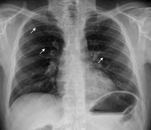Chest radiogram showing notching of the inferior surface of several ribs, bilaterally.
