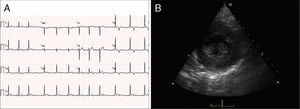 (A) 12-lead electrocardiogram showing the repolarization abnormalities described in the text. The voltage sum of the S wave in V1 and the R wave in V5 is 36 mm, but this patient was 19 years old, so the voltage criterion for left ventricular hypertrophy of ≥35 mm is not applicable; (B) echocardiographic image at the level of the papillary muscles (short-axis view at end-systole).