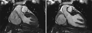 Coronal cardiac magnetic resonance images at end-systole (A) and end-diastole (B) showing the hypertrophic PMs.