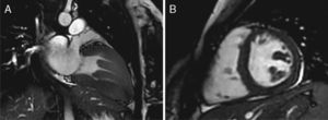 Long-axis cardiac magnetic resonance image at end-systole (A), and short-axis image of the papillary muscles at end-diastole (left ventricle, basal level) (B).