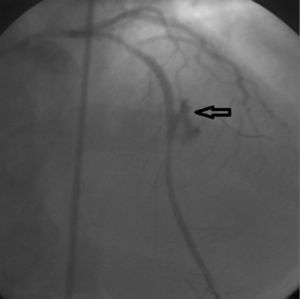 Left coronary angiogram in posteroanterior cranial view showing type I perforation in the mid left anterior descending coronary artery after stent implantation (arrow).