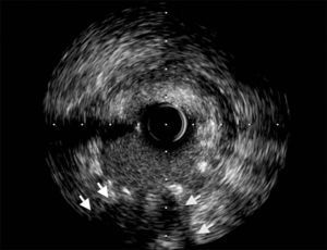 Intravascular ultrasound of the mid left anterior descending coronary artery showing loss of vessel wall integrity, damage to the adventitia and hyperechogenicity, suggesting a thrombosed pseudoaneurysm (arrows).