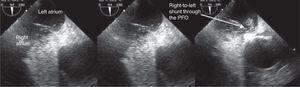 Transesophageal echocardiogram showing the passage of bubbles from the right to the left atrium, through the patent foramen ovale (PFO).