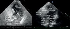 Transthoracic echocardiogram with administration of agitated saline, before (left) and after (right) closure of patent foramen ovale. After percutaneous closure, contrast no longer flows from the right to the left chambers.