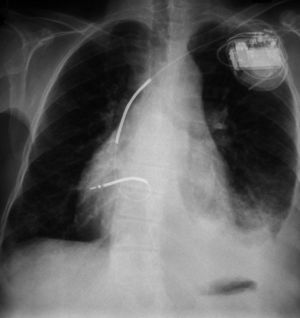 Radiografia de tórax que revela posição do eletrocateter (que se encontra dirigido para a direita) no ventrículo morfologicamente esquerdo.