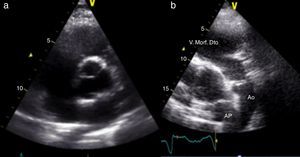 ETT: a) imagem anatomicamente normal em paraesternal eixo‐curto (PEE‐T); b) PEE‐T com grandes vasos paralelos e ventrículo morfologicamente direito anterior em continuidade com a aorta, também anterior (vídeo 1).