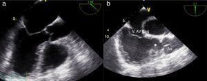 ETE: a) imagem anatómica normal; b) imagem correspondente mostrando ausência de continuidade entre a válvula aórtica e a válvula auriculoventricular esquerda (morfologicamente tricúspide), através de um infundíbulo (asterisco); ventrículo morfologicamente direito em posição esquerda e válvula aórtica em normal continuidade com vaso sistémico (aorta) (vídeo 2).