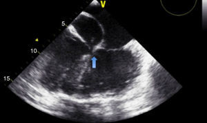 ETE: inserção das válvulas aurículo ventriculares no mesmo plano (seta), de acordo com associação de TCCGV com defeito de canal AV, que ocorre em até 75% dos casos2 (vídeo 3).