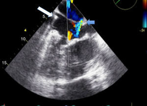 ETE: aurícula recebendo duas veias cava (aurícula direita); válvula AV morfologicamente mitral em posição direita; eletrocateter (seta branca) identificando veia cava superior e ventrículo morfologicamente esquerdo em posição direita; SIA com shunt residual baixo (seta azul) (vídeos 4 e 5).