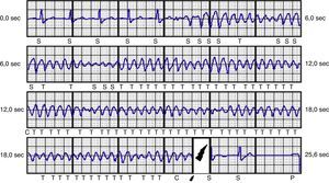 Eletrograma referente a terapia apropriada por taquicardia ventricular num doente com cardiopatia isquémica.