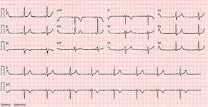 Resting ECG showing sinus bradycardia.