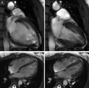 Left ventricular vertical (A) and horizontal (B) long-axis cine steady-state free precession magnetic resonance images at (a) end-diastole and (b) end-systole demonstrating normal ventricular systolic function and hypertrabeculation of left ventricular apical segments.