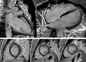 (A and B) Cardiac magnetic resonance late gadolinium images revealing no myocardial delayed enhancement.