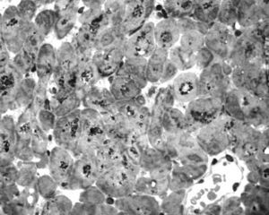 In this microscopic field from a semithin section of glutaraldehyde-fixed, epoxy resin-embedded tissue stained with toluidine blue, the majority of cardiac muscle fibers contain dark granular accumulations in their center.