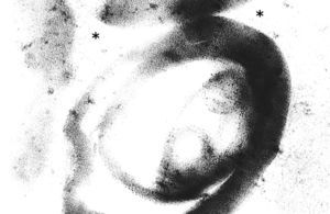 On electron microscopy the dark granules are made up of concentric laminae, clearly visible where they run perpendicular to the cut (asterisk).