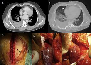 Computed tomography images showing (A) chest stab wound (arrow) and severe secondary right hemothorax with different densities inside suggesting different stages of bleeding (*) and (B) no pericardial effusion; (C) median sternotomy showing parasternal stab wound with no active bleeding (arrow); (D) active bleeding stab wound in the right atrium (arrow); the right lung is covered by the pleura (*); **: pericardial membrane; (E) stab wound in the right atrium sutured with a polypropylene suture buttressed with Teflon felt (arrow). The right lung is visible as the pericardium and right pleura are open (**). RA: right atrium; RL: right lung; RV: right ventricle.