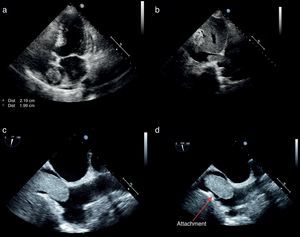 (a) Transthoracic echocardiography, apical 4-chamber view, showing a homogenous ovoid mass; (b) transthoracic echocardiography, subcostal view, showing the mass extending from the inferior vena cava to the right atrium; (c) transesophageal echocardiography, off-axis bicaval view, showing invasion of the inferior vena cava; (d) transesophageal echocardiography, bicaval view, showing the thin attachment of the mass to the right atrial inferoposterior wall.