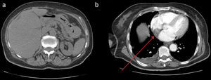 Total body computed tomography scan: (a) large metastatic mass in the right hepatic lobe; (b) thoracic level, the arrow indicating the RA filling defect.